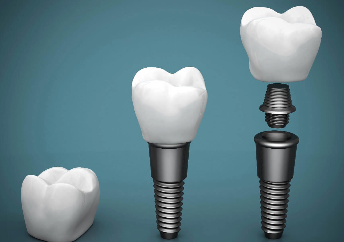 Dental Implants in Northridge CA area